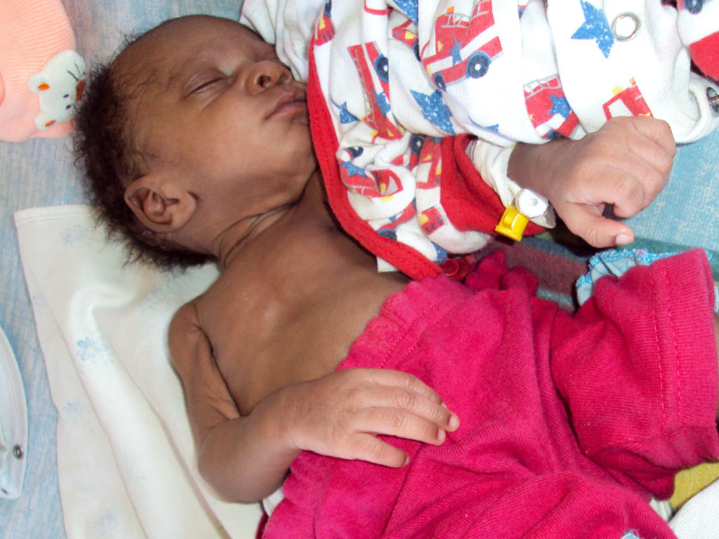 Kind mit Malaria