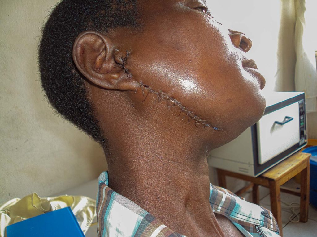 Frau Opfer eines Überfalls mit Messer - Burundi- Afrika